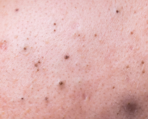Trị Mụn Đầu Đen Hiệu Quả Tại Sen Beauty